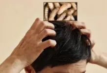 Sixth human case of screwworm in Yucatán