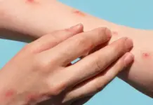 In Nuevo León, 2 of the 6 cases of monkeypox in Mexico in week 47