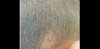 The first urban case of rickettsiosis in Mexico has been documented in a patient from Mérida, Yucatán.