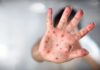 Measles surrounds Tabasco