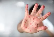 Measles surrounds Tabasco