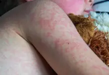 Measles outbreak in all 32 states of the country; Puebla reports a case