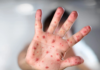 Two siblings test positive for measles in Querétaro; epidemiological surveillance is being reinforced
