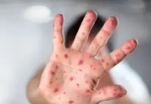 Two siblings test positive for measles in Querétaro; epidemiological surveillance is being reinforced