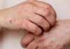 Puebla registers first case of measles; authorities search for more cases