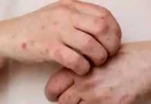 Puebla registers first case of measles; authorities search for more cases