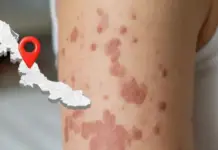 Confirmed: Xalapa registers the first case of measles in Veracruz this year.