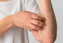 Coahuila ends the year with 55 cases of measles and Durango with 40