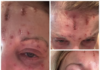 Foreigner undergoes cosmetic treatment in Puerto Vallarta and suffers severe burns to her face