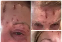 Foreigner undergoes cosmetic treatment in Puerto Vallarta and suffers severe burns to her face