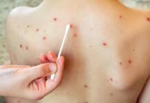 Outbreak reaches the state: Playa del Carmen registers the first cases of measles in Quintana Roo