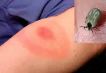 Calls for increased attention to pets following deaths from rickettsia