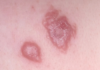 Quintana Roo leads Mexico in cases of cutaneous leishmaniasis