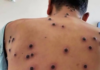 Monkeypox reaches 12 cases on the Yucatan Peninsula