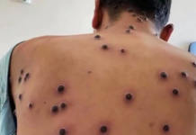Monkeypox reaches 12 cases on the Yucatan Peninsula