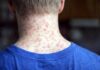 Mexico Faces Severe Measles Surge as Reported Cases Double