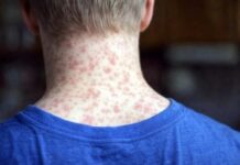 Mexico Faces Severe Measles Surge as Reported Cases Double