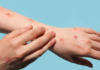 Durango records 607 measles cases and Coahuila 167 in 2026.
