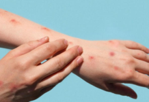 Durango records 607 measles cases and Coahuila 167 in 2026.